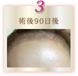 術後90日後