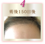 術後150日後