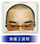 施後2週間