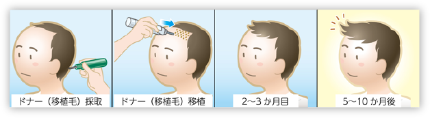 自毛植毛の流れ
